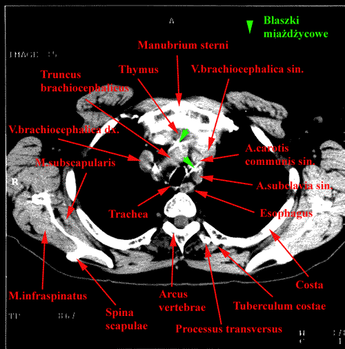 anatomia radiologiczna - 31.gif